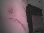 body armor scar