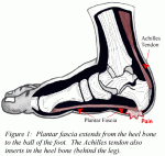 Plantar Fasciitis heel Pain
