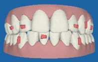 Invisalign Part 10 1 invisalign-3d-front-view