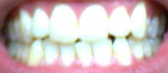 Aligner Set 1 - The Beginning