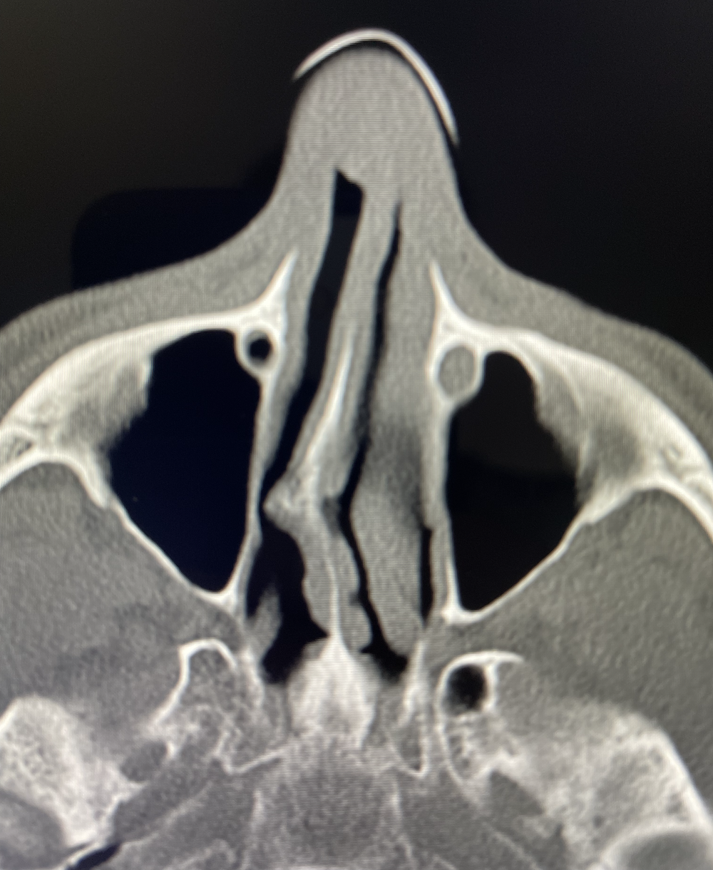 Are Ear Snap, Crackle, Pops a Eustachian Tube Disorder!?